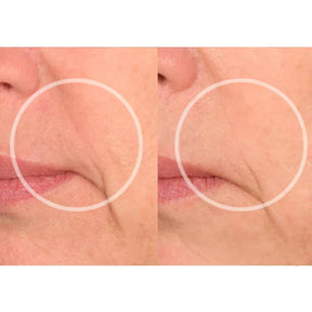 Smile Rejuderme® Skinlet