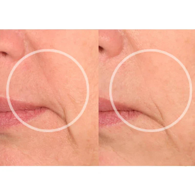 Smile Rejuderme® Skinlet