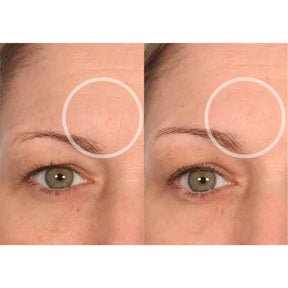 Forehead Rejuderme® Skinlet