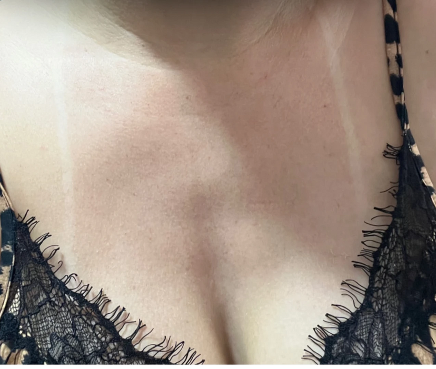 Keila - After the Skinlet